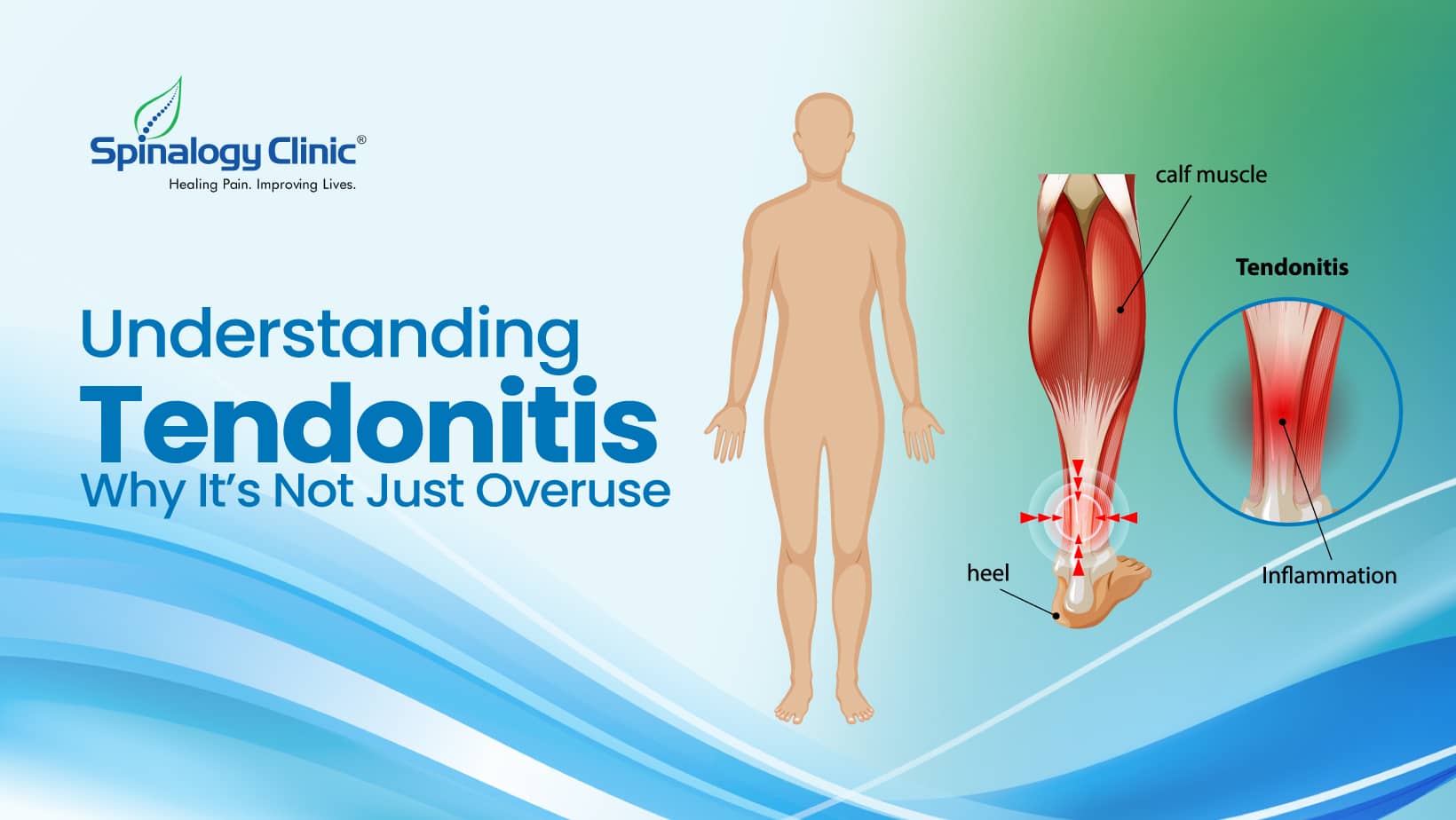Tendonitis and Overuse: What You Really Need to Know